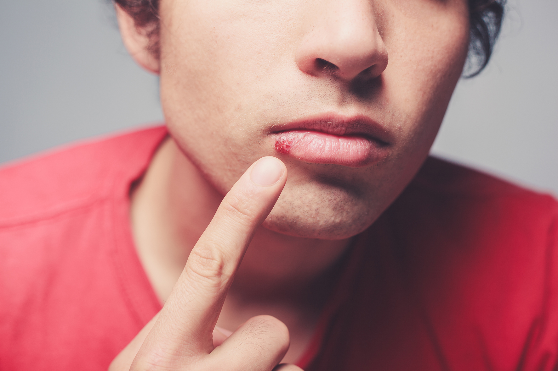 Young man with cold sore