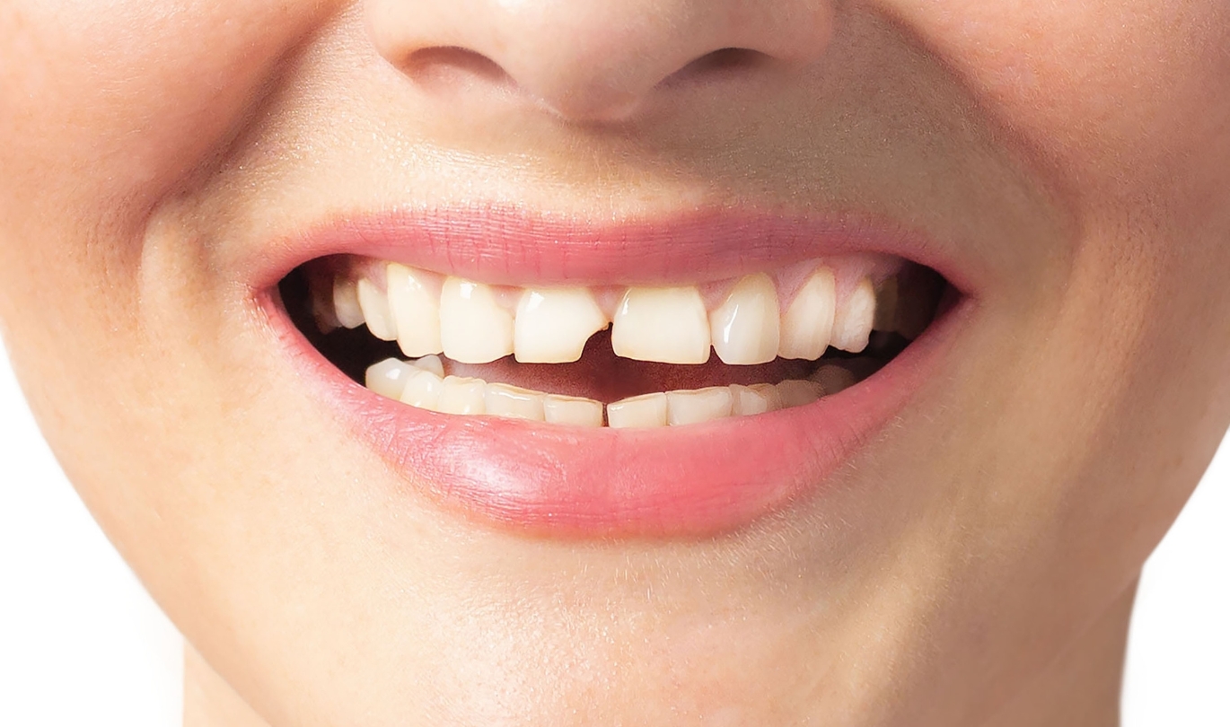 Broken Teeth
