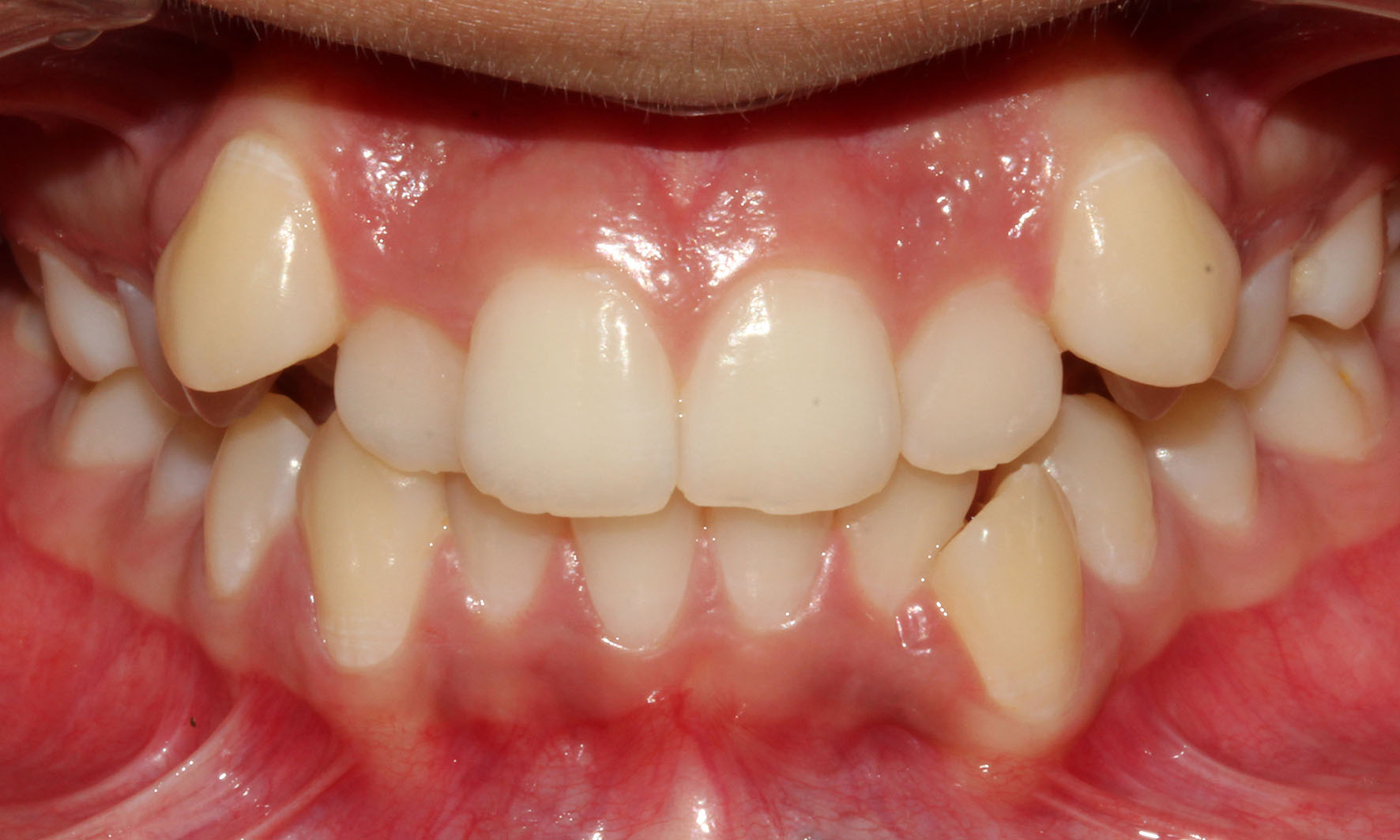 A Child with Crooked teeth
