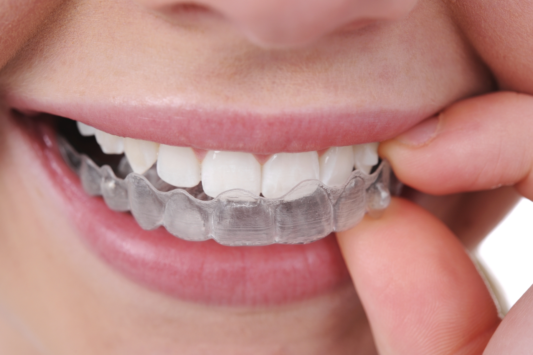 invisalign-large