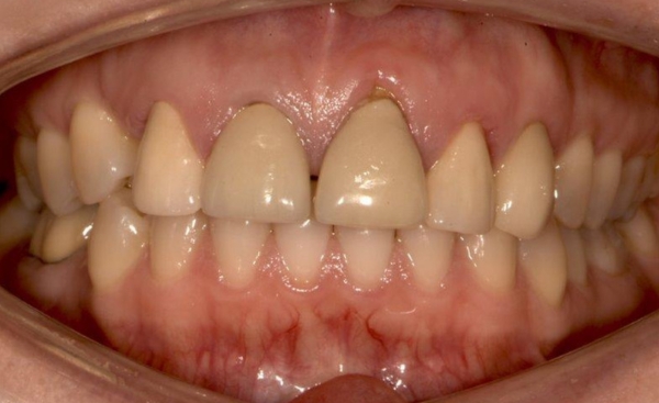 Porcelain Veneers before